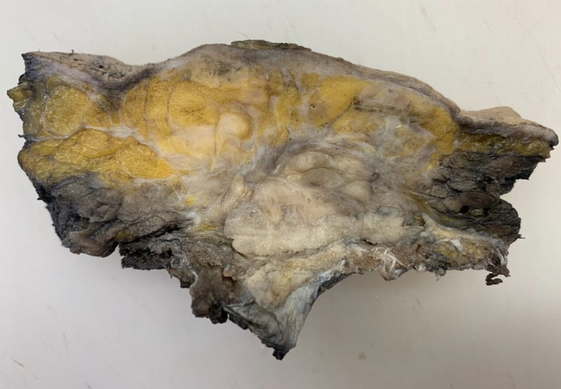 Case presentation. A 68 yo woman with a history of left breast cancer treated with surgery and radiation 6 years ago. A 5.4x5cm left infraclavicular tumor was resected. Final Dx. Radiation associated high grade sarcoma, part 1#pathresidents #pathology #pathtwitter #sarcoma