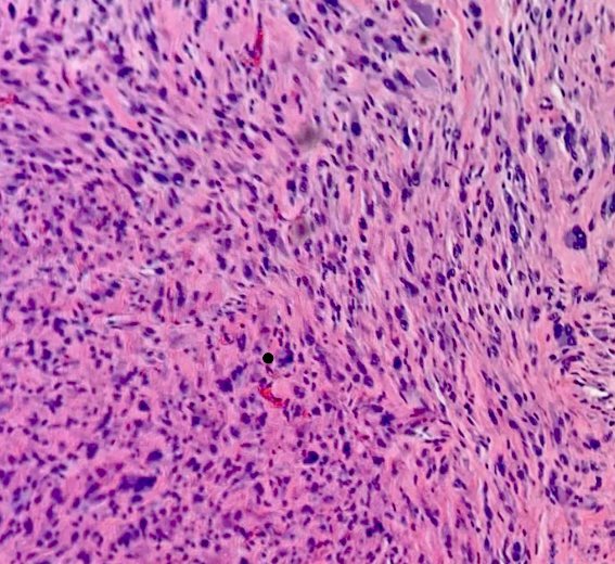 Case presentation. Part 2 . A68 yo woman with a HO of Breast IDC NOS, treated with surgery and radiation. Final Dx.Radiation associated high-grade Sarcoma #pathresidents #pathology #pathTwitter #sarcoma