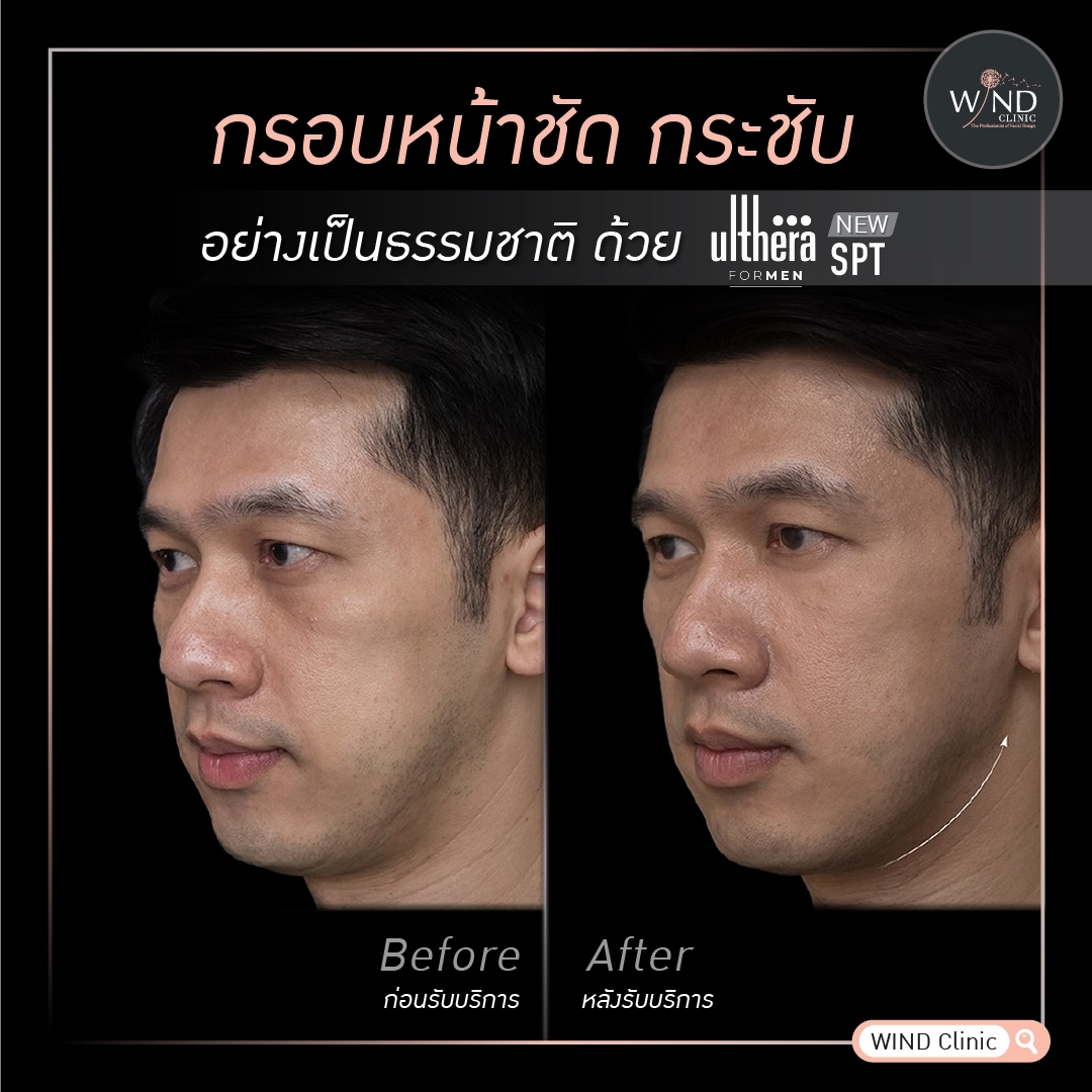 windclinic's tweet photo. จัดการปัญหากรอบหน้าไม่ชัด   ด้วย  Ulthera For men  
ยกกระชับระดับลึกถึงชั้นกล้ามเนื้อ smas 
ผิวเรียบตึง ไร้ริ้วรอย 

#หมอบาส_นายแพทย์เฉลิมชัย_ศรีอัครพงศ์
#ปรับรูปหน้า #มืออาชีพตัวจริง #ปรับรูปหน้า #ยกกระชับใบหน้า #หน้าตึง #เติมโบ #WINDCLINIC https://t.co/djdfqTbyfE