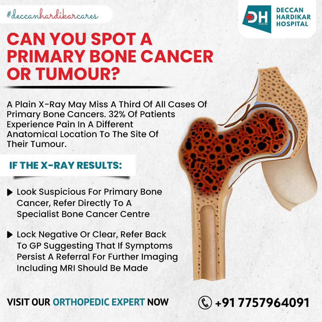 To learn more, contact us today at 7757964091 to schedule an appointment with our experts, or go to deccanhospital.in
#deccanhardikarcare #pune #punecity #boness #multispecialityhospital #bonecancer #cancer #shivajinagar #pune #deccanhardikar