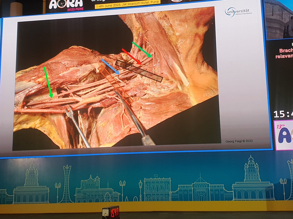 #AORA23 
Dr George enlightening the full house on brachial plexus anatomy..<a href="/Ropivacaine/">Dr. Vishal Uppal MBBS, FRCA 🇨🇦🇮🇳🏴󠁧󠁢󠁳󠁣󠁴󠁿</a> <a href="/AparnaJayaraj4/">Aparna Jayaraj</a> <a href="/DrTuhinM/">Tuhin</a> <a href="/Sdiwan14Diwan/">sandeep diwan</a> <a href="/anesthetix/">Amjad Maniar</a> <a href="/Archana_Areti/">archana areti</a> <a href="/ram03kul/">Rammurthy Kulkarni🇮🇳</a>