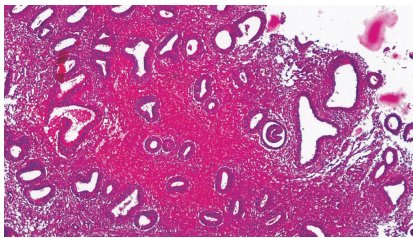 Expression of PTEN Marker in Endometrial Hyperplasia without Atypia: One-year Observational Study jsafog.com/doi/JSAFOG/pdf… #Endometrialcancer #Endometrialcarcinoma #Endometrialhyperplasia #PTEN #JaypeeJournals #JSAFOG #JaideepMalhotra