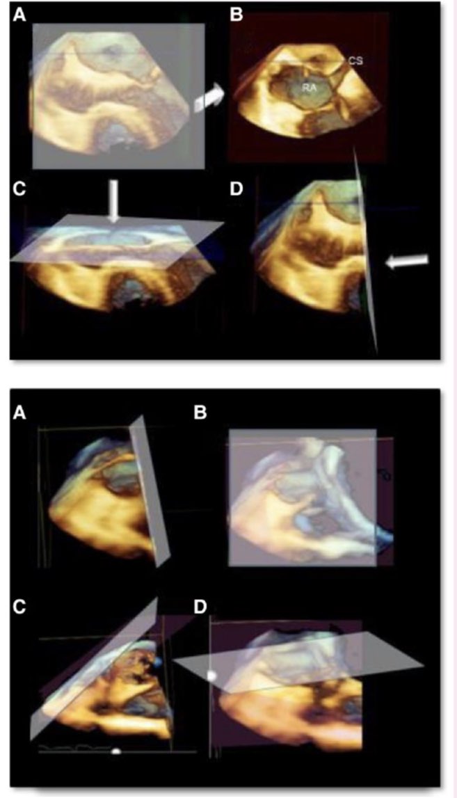 HOW to use and WHEN to use transesophageal #3DEcho in clinical practice 

🌟Beautiful EACVI consensus document in #EHJCVI 

doi.org/10.1093/ehjci/…
 
<a href="/EACVIPresident/">EACVI President</a> @GeraldMaurer <a href="/NAjmoneMarsan/">Nina Ajmone Marsan</a> <a href="/DonalErwan/">Donal</a> 
<a href="/Cosyns/">Cosyns Bernard</a> 
<a href="/ThorEdvardsen/">Thor Edvardsen</a> 
<a href="/Sarah_Moharem/">Sarah Moharem Elgamal, MBBCh, MSc, PhD👩🏻‍⚕️🫀</a> 
<a href="/hahn_rt/">RTHahnMD</a> 
<a href="/robertomlang/">Roberto M Lang</a>