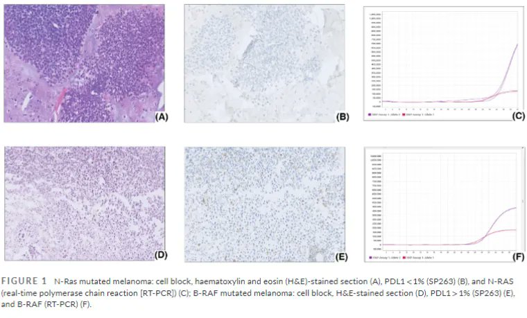 CytopathologyJ's tweet photo. Cell block material with atleast 100 viable cells is adequate for PDL-1 testing! And a dedicated rinse in nuclease-free water can be used later for molecular testing! #MoreFromLess #MolCytology #CytoJ https://t.co/cjH82Ub7IH