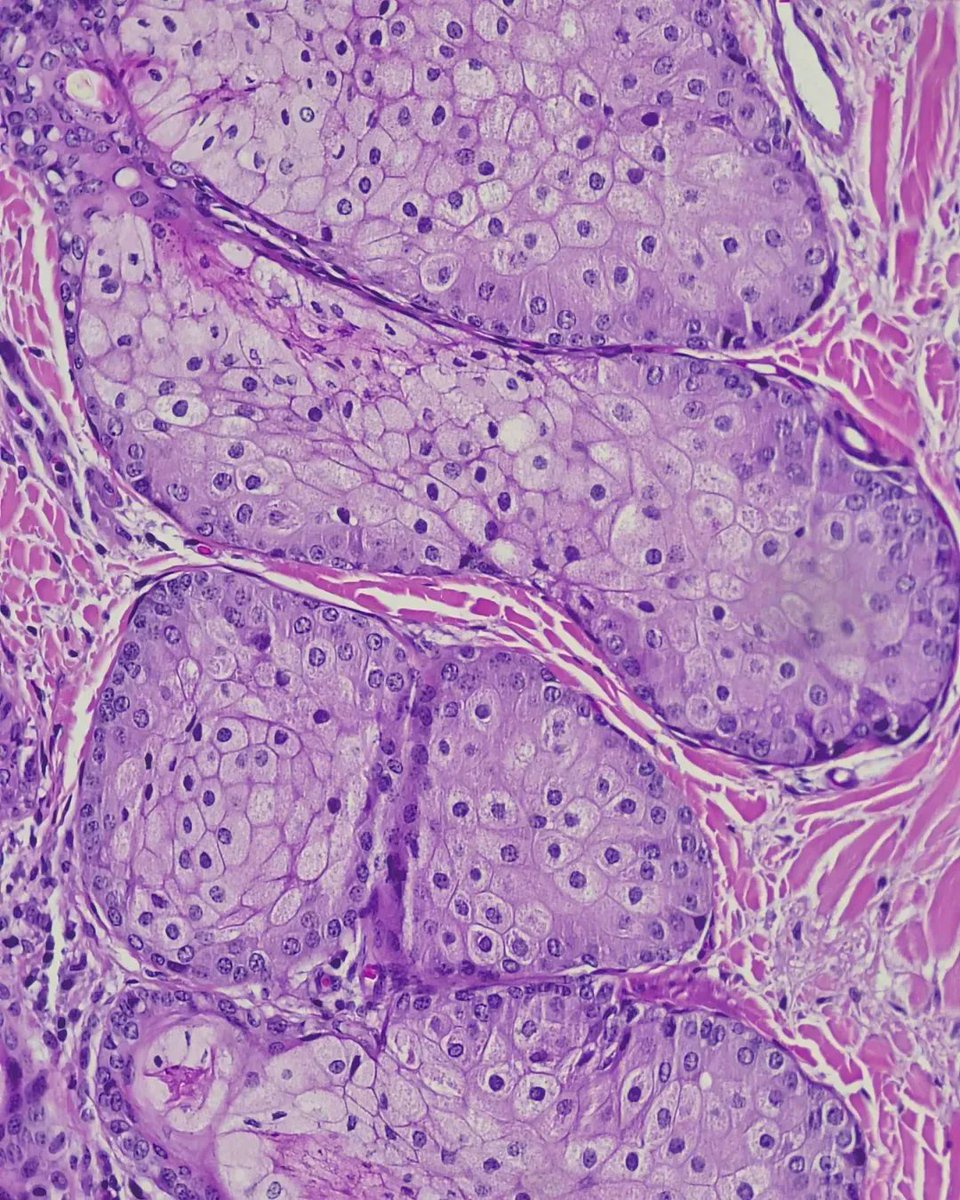 olkazuraw's tweet photo. These are sebaceous glands, that you will find in haired skin.

#digitalpathologyart
#dppart
#pathart
#microscopicphotography 
#microart 
#digitalpathology 
#digitalartwork https://t.co/JOxKpxpm5v