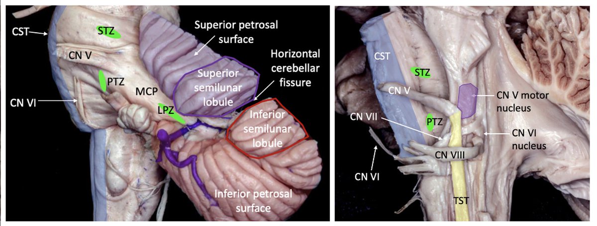 #MorcosChallenge Three lateral entry zones to the pons are centered around CN5: supratrigeminal zone (STZ), peritrigeminal zone (PTZ)& lateral pontine zone (LPZ). STZ incision is in the MCP above CN5; PTZ between CN5 &CN7/8; LPZ in the posterolateral MCP @EvaWuMD @medclinicalcase