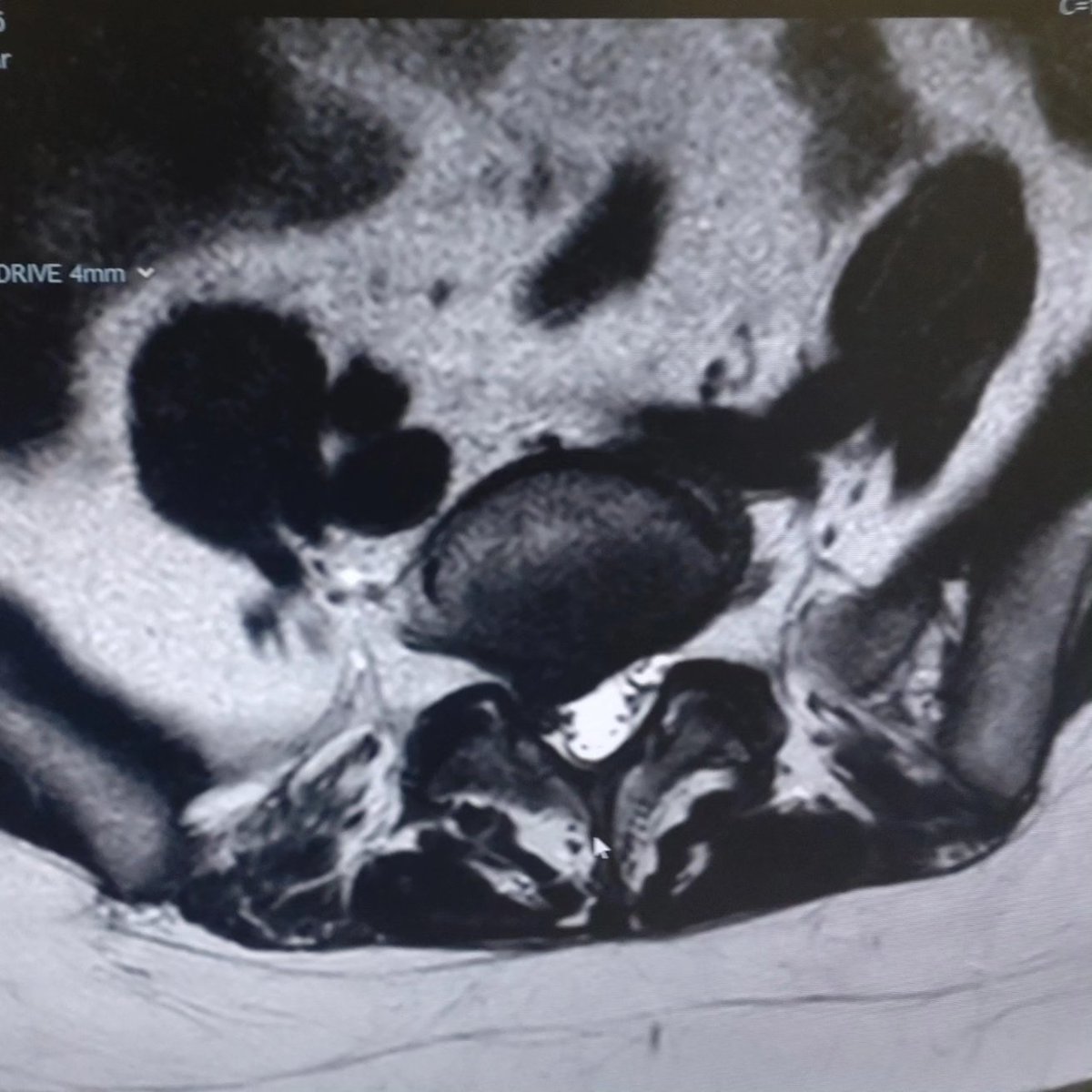 roisin_aiston's tweet photo. Pretty cool to be able to see what my spine looks like!😄Also I now get to look at the little rascal of a disc that has been causing so many problems&amp;say some choice words to it! 🤬 Absolutely unrepeatable of course, but glad to know what the problem is and just keep going! 😁 https://t.co/xZlgo6kYkg