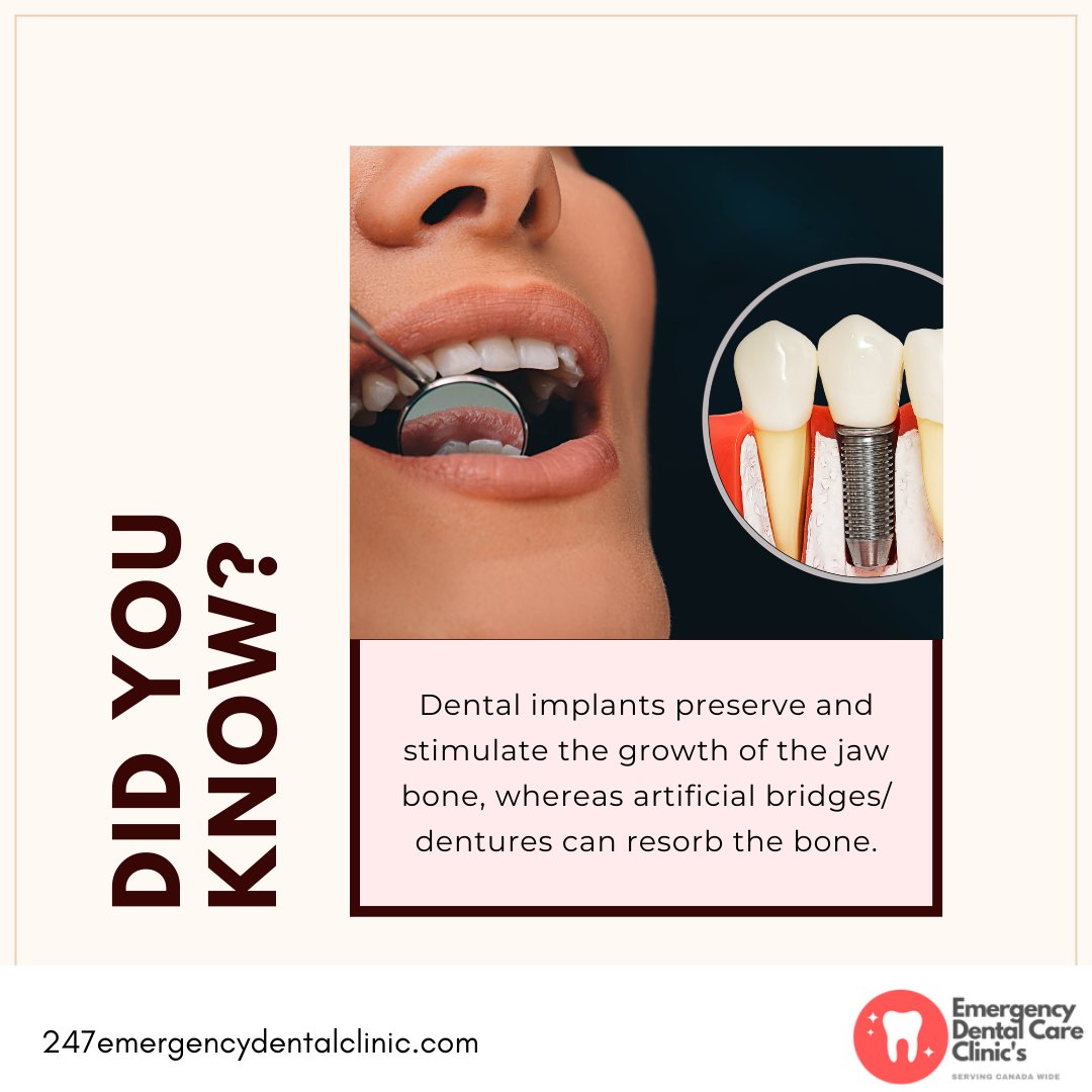 Prevent bone resorption: embrace dental implants for long-term oral health.
Visit us at zurl.co/uvba 

#247emergencydentalclinics #dentalemergency #dentalcare #dentalclinic #dentalhealth #healthyteeth #canadadental