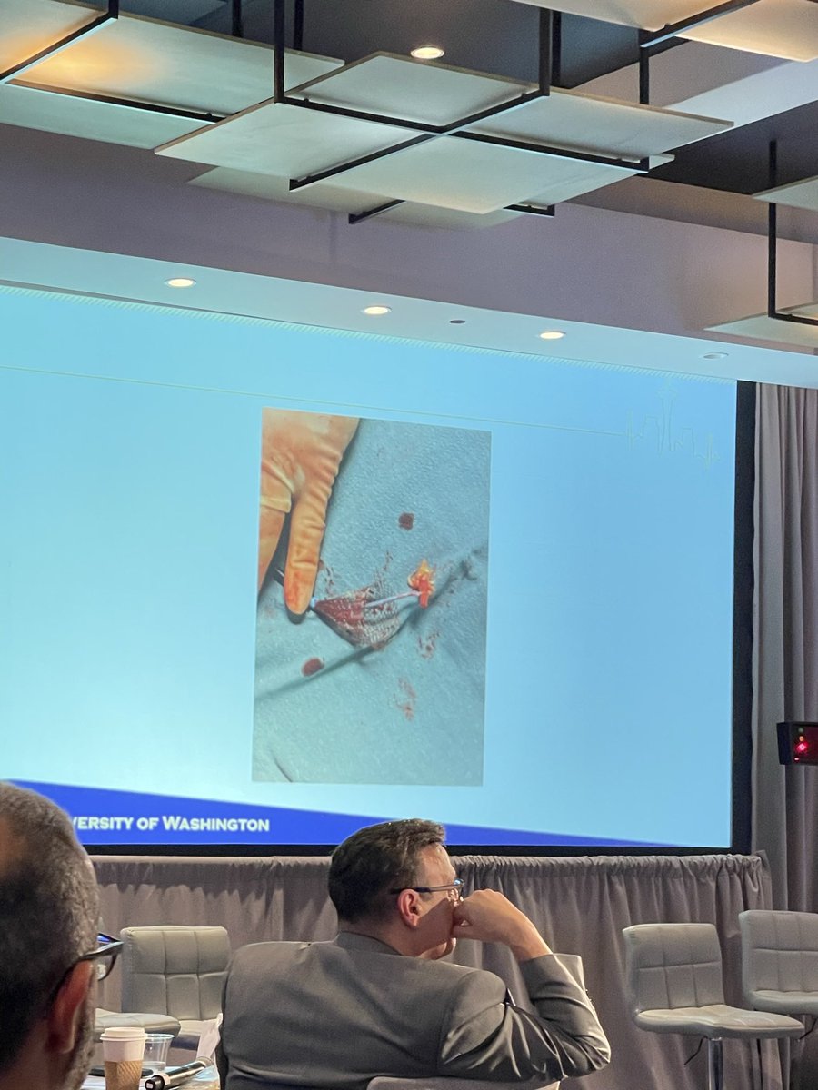 sbrugaletta's tweet photo. How to remove a clip from @jamiemccabeMD with a subsequent Sapien implanted. Incredible case!first time to the best of my knowledge a clip is removed #ELASTAclip with the use of a special basket @PCRonline @OPCILive #OPCIlive https://t.co/A2F5Qzl7Jc