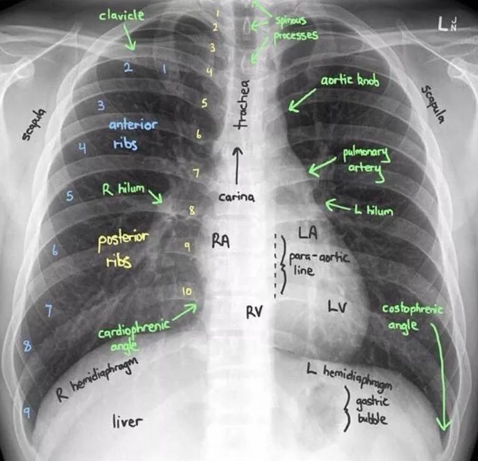 medizzycom's tweet photo. Labeled chest x-ray!

Shared in the MEDizzy App: https://t.co/uXkFNB5dgv

#medicine #medicaleducation #xray https://t.co/uEUyB3sbQb