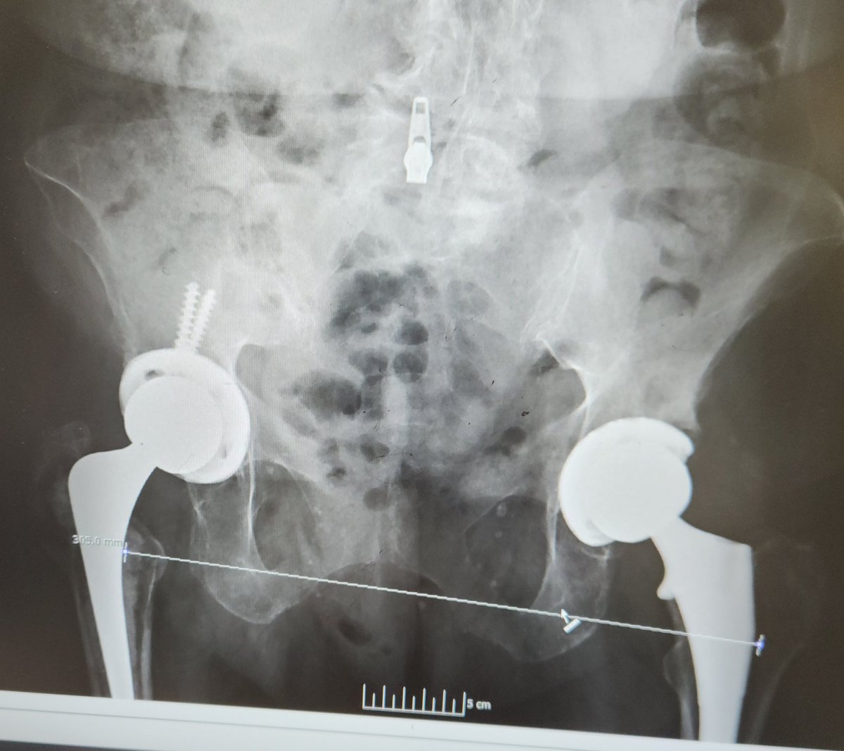 Pt from OSH 1 month po from l tha. Large LLD. Pt unhappy. Does not want to consider shoe lift. R Tha 15 yrs out but doing well. What options should I offer her?
#orthotwitter <a href="/CenterRotation/">Brock Howell MD, FAAOS</a> <a href="/EdinburghKnee/">Chloe EH Scott</a> <a href="/generalorthomd/">Very General Orthopaedist</a> <a href="/jointdocShields/">John Shields, MD, FAAOS</a> <a href="/wesmayes12/">Wes Mayes</a> <a href="/ACR_MD/">Anna Cohen-Rosenblum</a> @LindaSuleimanMD