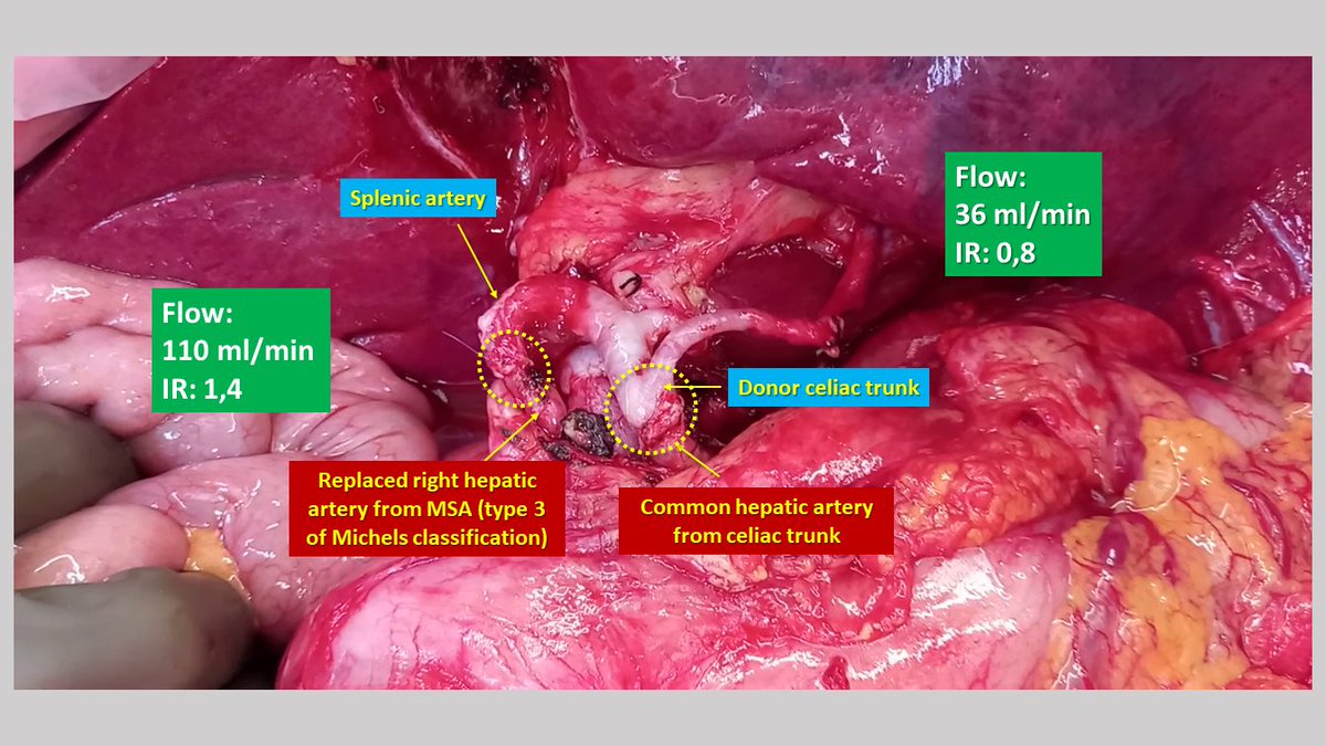 pplo59's tweet photo. Double arterial revascularization of a liver graft...🤔🤔🤔Why not ?  👇👇👇

https://t.co/SHFInLPs24 https://t.co/Hj6hca4LaV