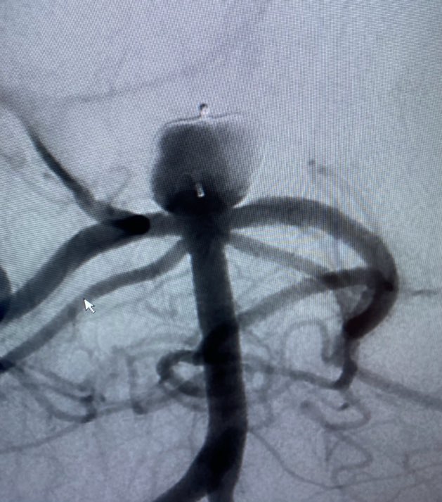PenNeuro's tweet photo. US HCPs: Radial access with #BMX81 to a V3 position, accommodating 5F Sofia to support WEB placement at the University of Arkansas. Thank you for sharing, Dr. Satya Patro! For risk info: https://t.co/iWWO7Bfk2R Clinical results may vary. https://t.co/kphTPy3Dfj