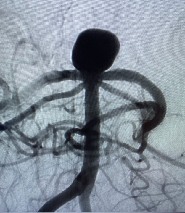 PenNeuro's tweet photo. US HCPs: Radial access with #BMX81 to a V3 position, accommodating 5F Sofia to support WEB placement at the University of Arkansas. Thank you for sharing, Dr. Satya Patro! For risk info: https://t.co/iWWO7Bfk2R Clinical results may vary. https://t.co/kphTPy3Dfj