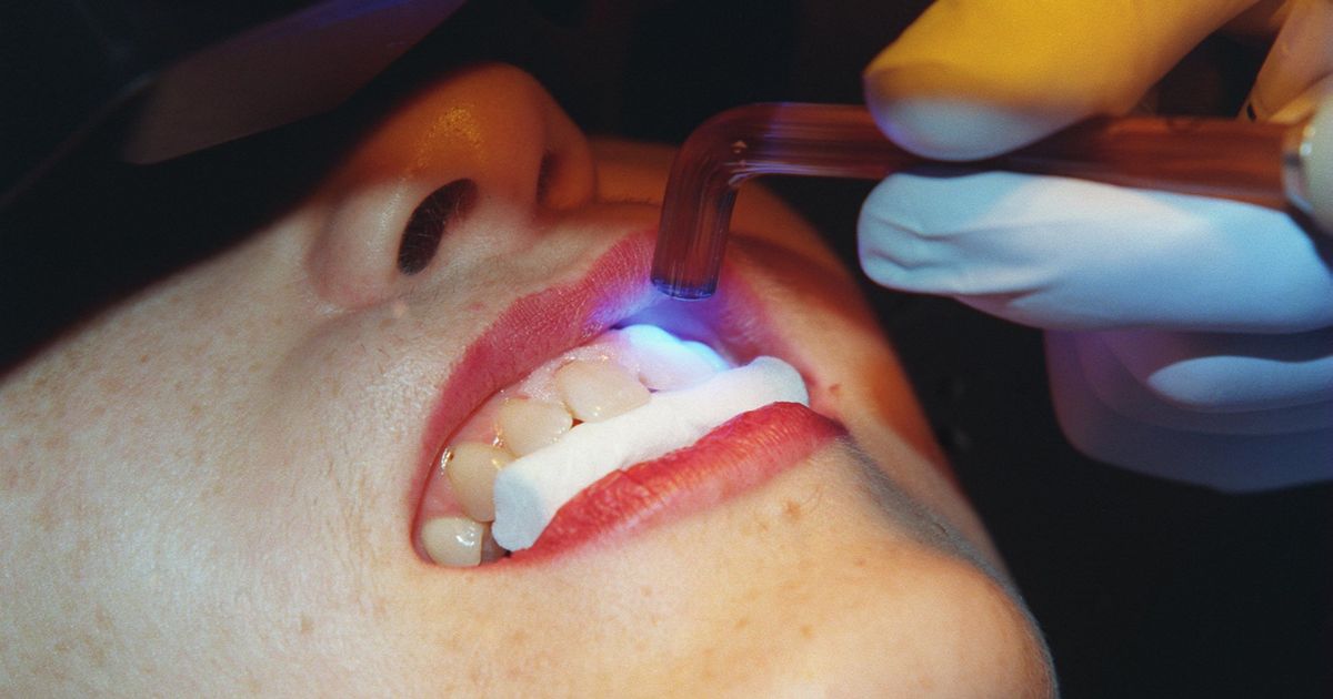 SmilesWimbledon's tweet photo. Teen left with teeth falling out after illegal teeth whitening https://t.co/gMGQBkNJsy https://t.co/BSOYXojI88