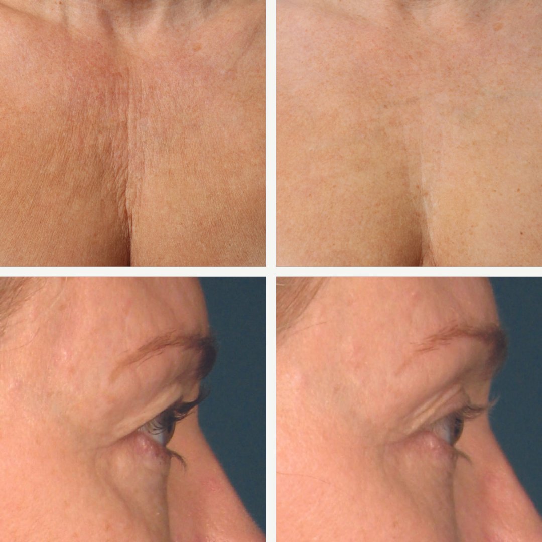 Here are some before and after photos of our clients who chose Ultherapy. As you can see, the results are impressive and natural-looking. #RealResults