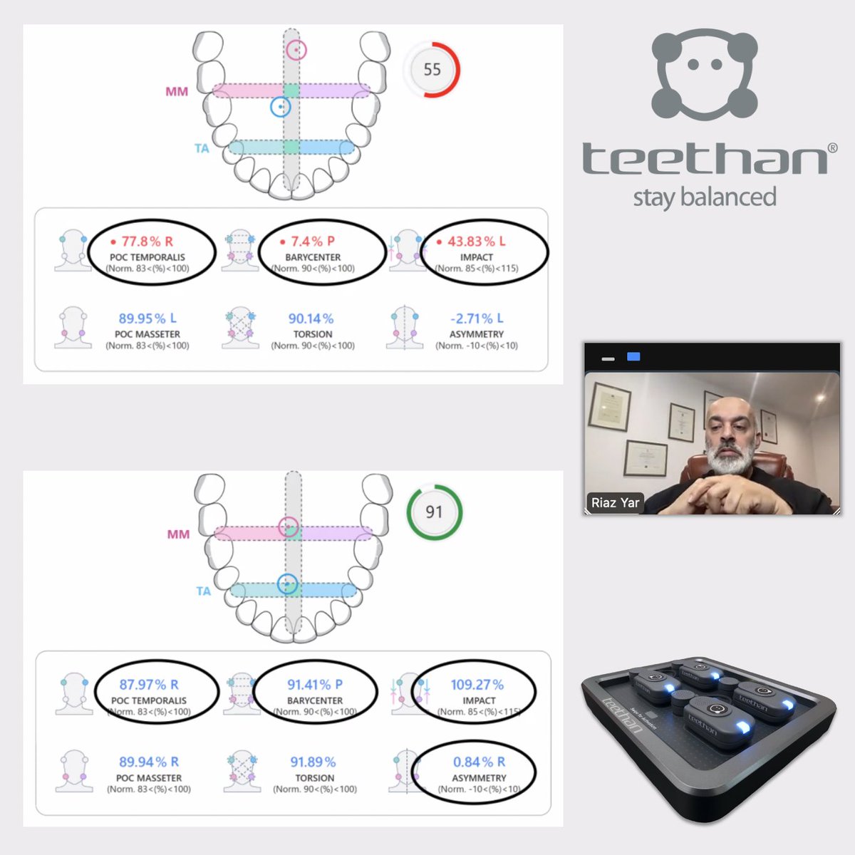 A fantastic insight into the use of #Teethan in daily practice from Prof. Riaz Yar in our latest webinar! 👇 tinyurl.com/profriazyartee…