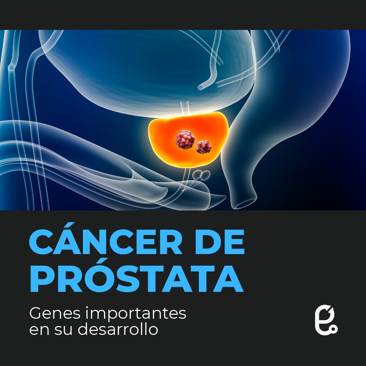 Reto_MD_'s tweet photo. Las alteraciones genéticas en el cáncer, como las mutaciones en genes reguladores y cambios en las proteínas y su cantidad, conducen al desarrollo de células anormales y al progreso del cáncer. #enarm #retoenarm #medicina #medicinaenarm #examenenarm #ENARM #examenENARM https://t.co/z8RW4urRAy
