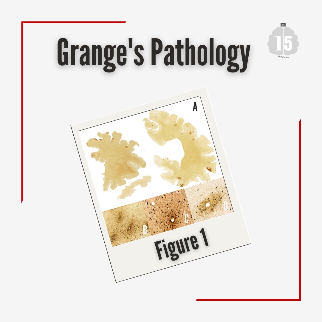 bu_cte's tweet photo. As we close out our #Flashback15 spotlight on Patrick Grange, learn more about his CTE diagnosis. We would like to thank the Grange family for their generous donation and contribution to our research.
(1/2) https://t.co/i46u9boFZj