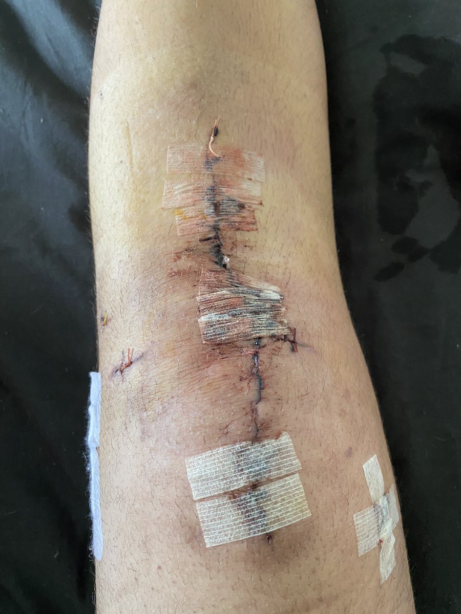 MonsieurToinou's tweet image. #postoperation