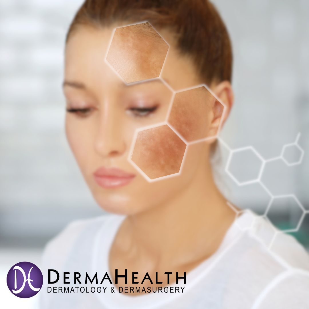 DermaHealthDerm's tweet photo. Hyperpigmentation affects many people, but there are ways to treat it. Talk with a skin care expert today! #skincaretreatment #evencomplexion https://t.co/NbjpCWYbCV