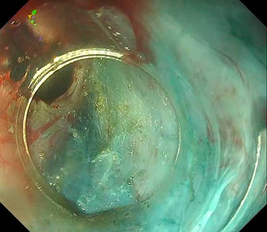 New quiz: A patient presents for a re-do peroral endoscopic myotomy (POEM) for achalasia after recurrence of dysphagia symptoms. She underwent POEM 3 years prior with improvement in symptoms. During submucosal tunneling, there is an adverse event (image). videogie.org/doi/story/10.1…