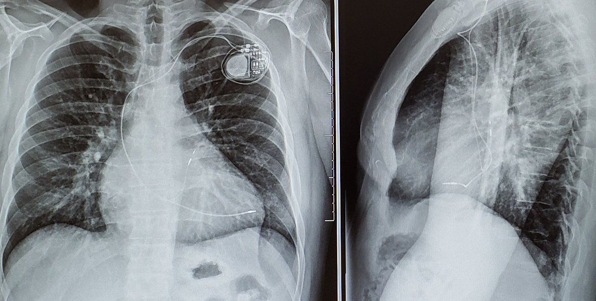 Chest X-ray is a great tool . Lateral view is a must , as PA views can be reassuring or misleading sometimes.  45 yr man with dual ppm . 1 yr after implant. Thoughts ? <a href="/RogueRad/">Saurabh Jha</a> <a href="/EJSMD/">Edward J Schloss MD</a>  <a href="/adribaran/">Adrian Baranchuk MD FACC FRCPC FCCS FSIAC</a> <a href="/narrowQRS/">JMC</a> <a href="/HanCardiomd/">Henry Han</a> <a href="/ShaojieChen1/">Shaojie Chen</a> <a href="/doc_ccc/">Colin C</a>