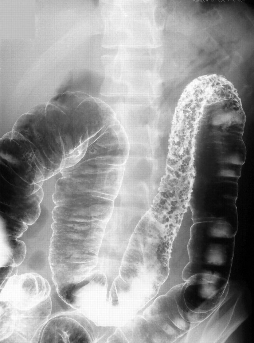 GesconsEduca on Twitter "🧪Paciente quien ingresa con diarrea crónica