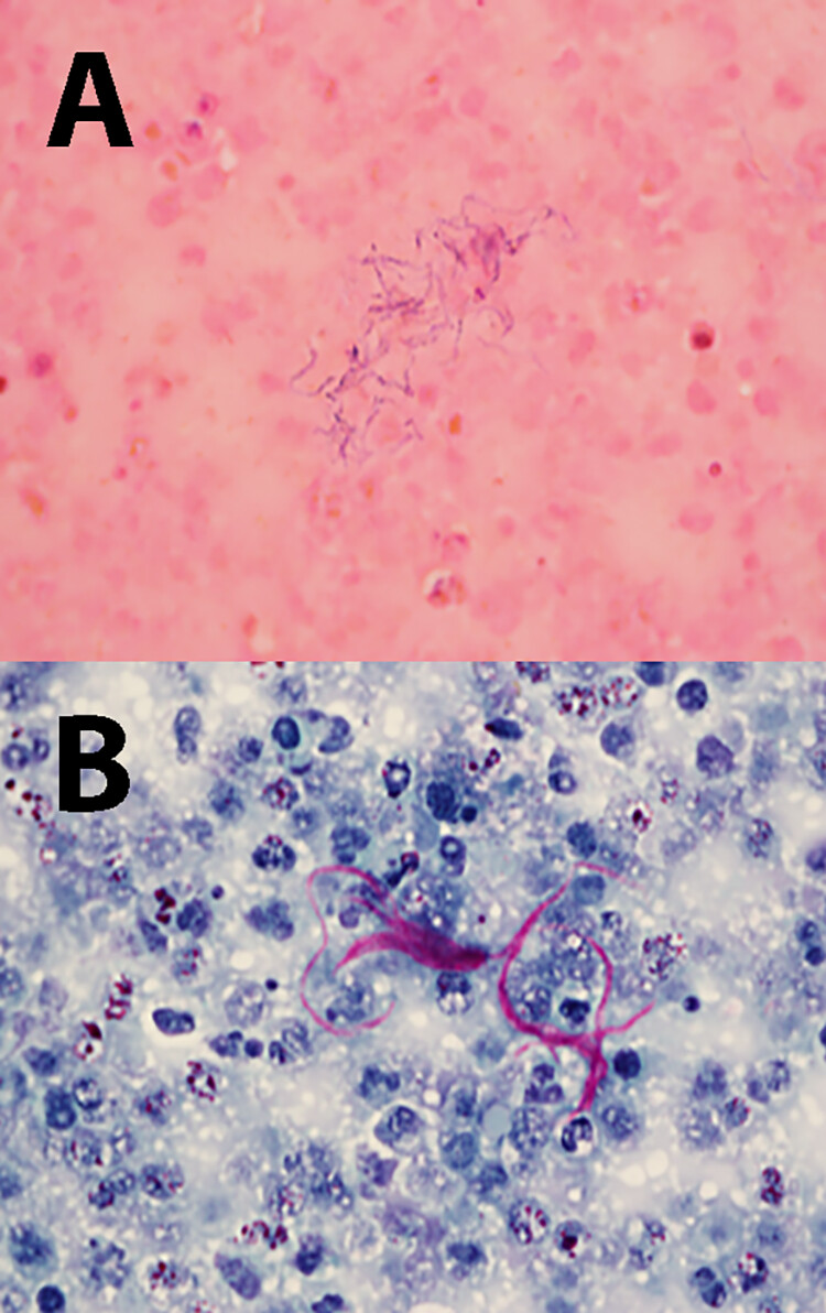 JClinMicro EIC on Twitter "The Brief Case Strictly Anaerobic and