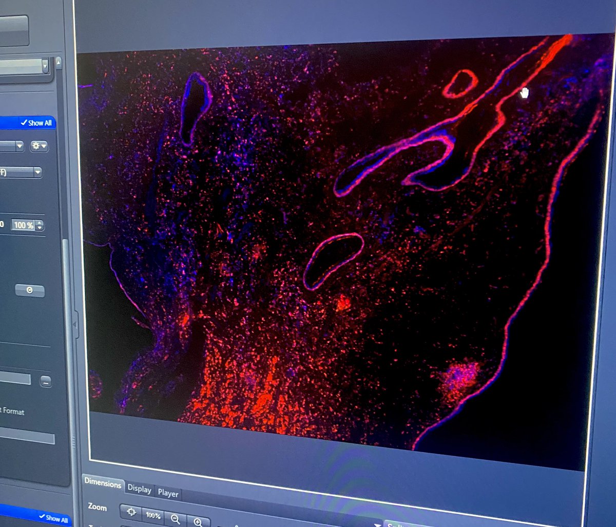 Used LiBH4 to inactivate AF647 for two rounds of imaging on #NasalPolyps. High-plex images coming soon 👀. Happy #FluorescenceFriday! 

@CalmMcmaster @zeiss_micro #Optimization #IBEX #MultiplexedImaging #Immunofluorescence