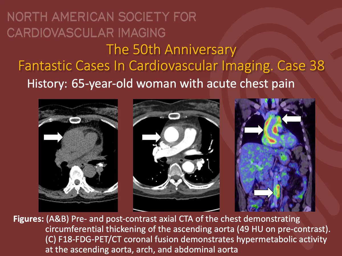 #NASCI 50th Anniversary Case Series

Case 38 Diagnosis

#whyCMR #YesCCT

@GregKicska @JRevRad1 @dianalitmano @DanielVargasMD @kirschj @prachipagarwal  @AwsHamid5  @CarlottaOnnis @DeCeccoCN