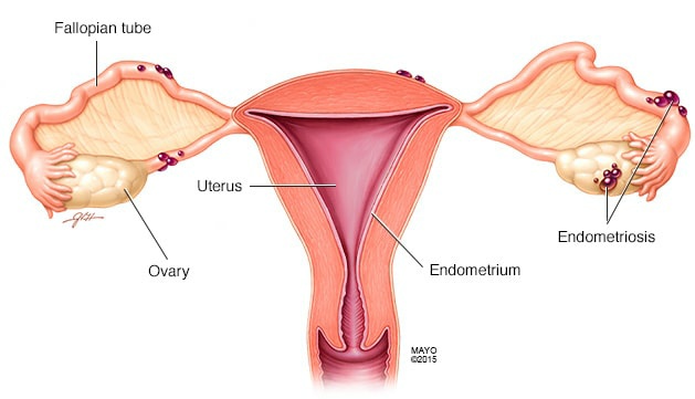 drapeggipinango's tweet photo. La ENDOMETROSIS afecta aproximadamente al 10% de la población femenina. Su principal síntoma es el DOLOR con la menstruación, y también causa infertilidad. La primera medida como tratamiento es la alimentación baja en carnes rojas, lácteos y gluten. Practicar ejercicio. https://t.co/v4mbOxApLx