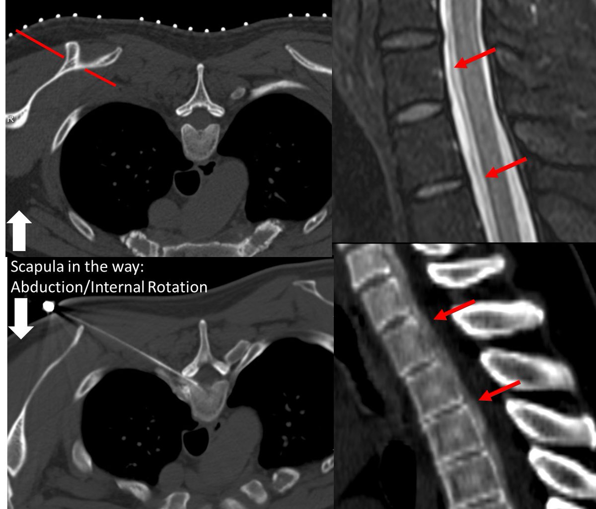 When scapula blocks your path to patch the ventral #CSFleak, a little disco move can sometimes open things up just enough…