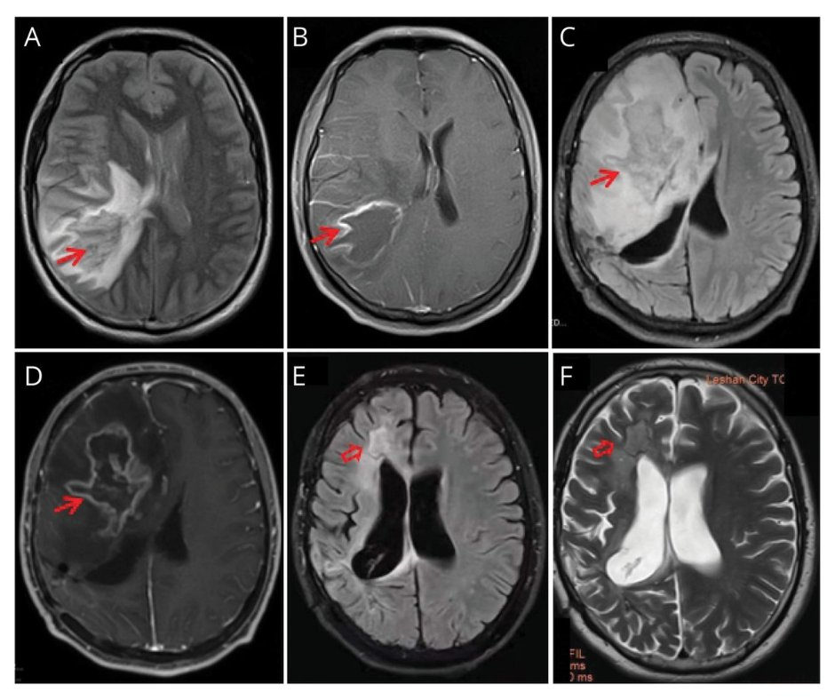 Teaching NeuroImage: Primary CNS Vasculitis Mimicking Intracranial Tumor bit.ly/3oACpLM

#NeurologyRF #NeuroTwitter