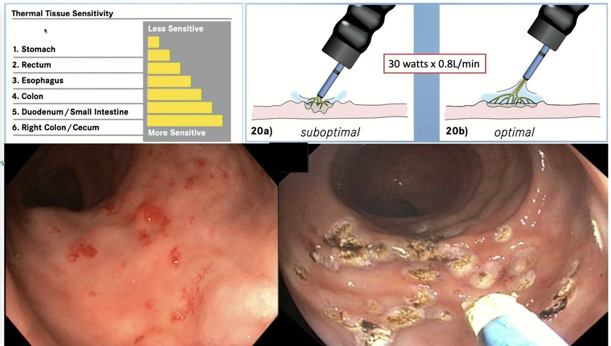 When applying APC for AVMs ⚡️‼️ Tips from Prof. Holt 🏆🇦🇺 #GITwitter #AIM2023

✳️ In the right colon, consider small-volume injection underneath the lesion to prevent micro perforations
⚠️ Check out thermal tissue sensitivity 👇 When in the right colon, minimize wattage used