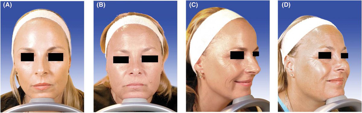 في متابعة اخرى بعد 6 سنوات الفوارق تتضح بشكل اكبر مثبتة فائدة البوتوكس في الحفاظ على شباب الوجه ونضارته اضافة الى الفوائد المعروفة بمكافحة التجاعيد الحركية
الروابط
rmclinic.co.uk/4653-2/

doctorbinder.com/pdf/Academic/t…
