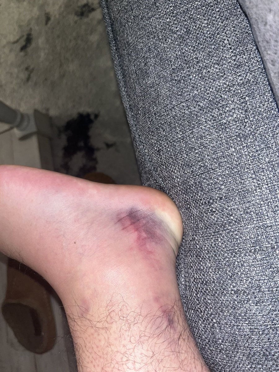 Matt_Straus1's tweet photo. Summer of 2023 is brutal y’all. I graduated 6 days ago, &amp; these things have happened:

1) sprained/fractured my ankle
2) me and my gf of 3 years broke up 
3) instagram &amp; snap got hacked, down $1500
4) best friend moved to Texas 

Send prayers, faith is still high as ever! ✝️👏🙌 https://t.co/e3vy9nAdlg