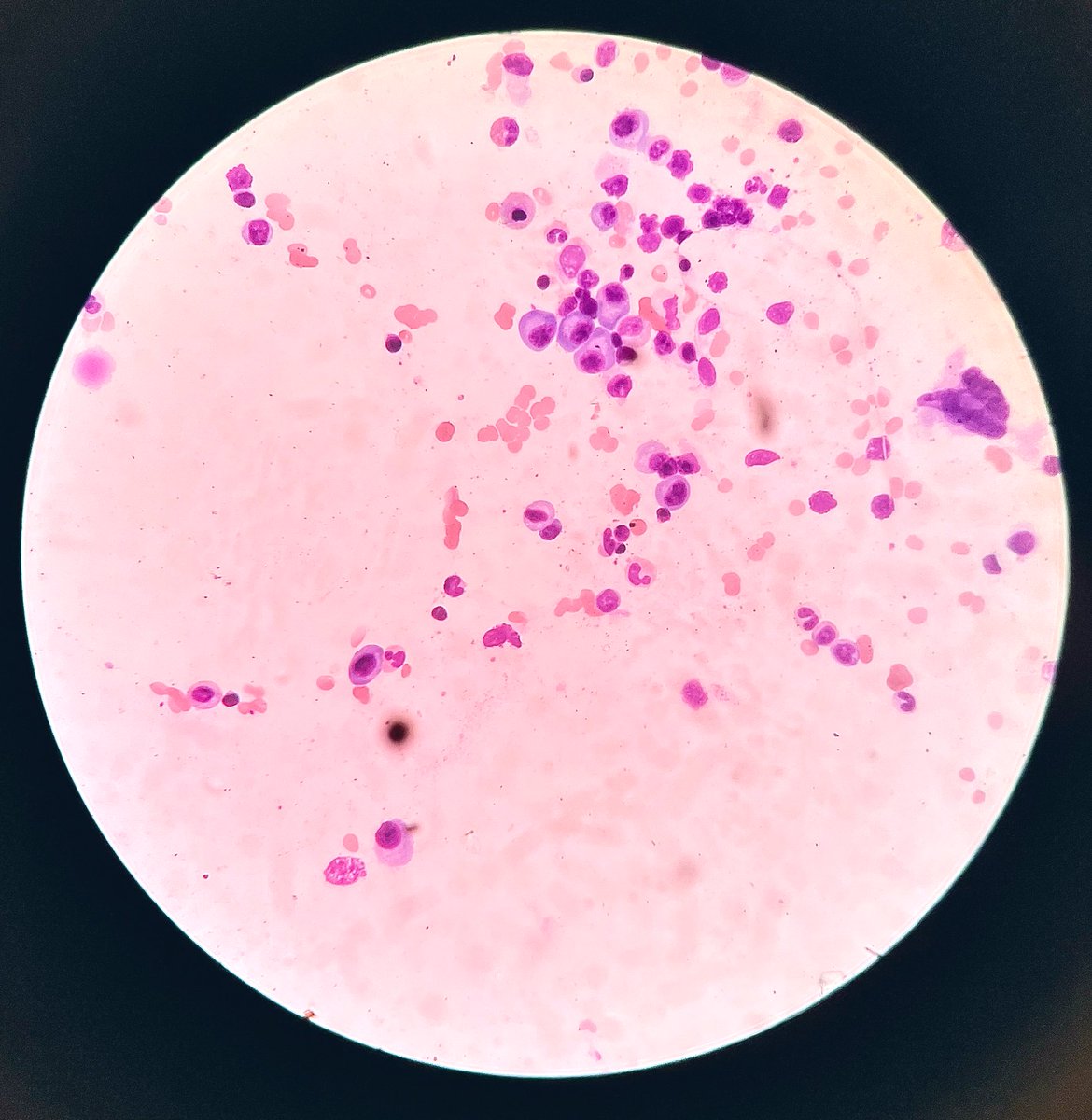 What are you having for breakfast? I’m having fried eggs. #PathTwitter #hemepath