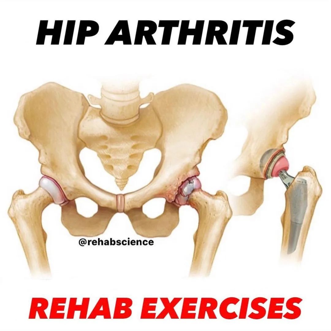 Hip Arthritis Rehabilitation Exercises