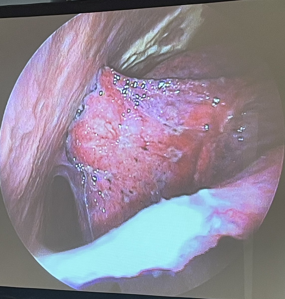 2 days of learning to perform medical thoracoscopy for the diagnosis and treatment of unexplained pleural effusions 🫁. This amazing procedure has few complications, and has a high utility in clinical diagnosis and treatment with a diagnostic yield of >95% 🤩