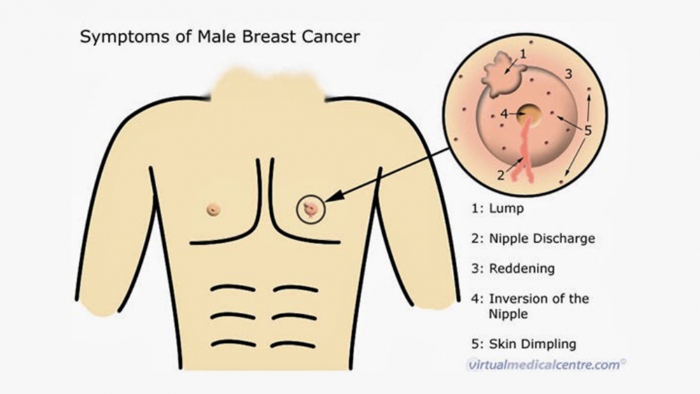 Symptoms -the presence of a lump/swelling in the breast or under the nipple, nipple retraction/ inversion, nipple discharge, changes in the skin's appearance
#MaleBreastCancer #mbc #endcancer #MyHealth #earlydetectionsaveslives
@malebreastcncr @malebreast 
onlymyhealth.com/can-men-get-br…