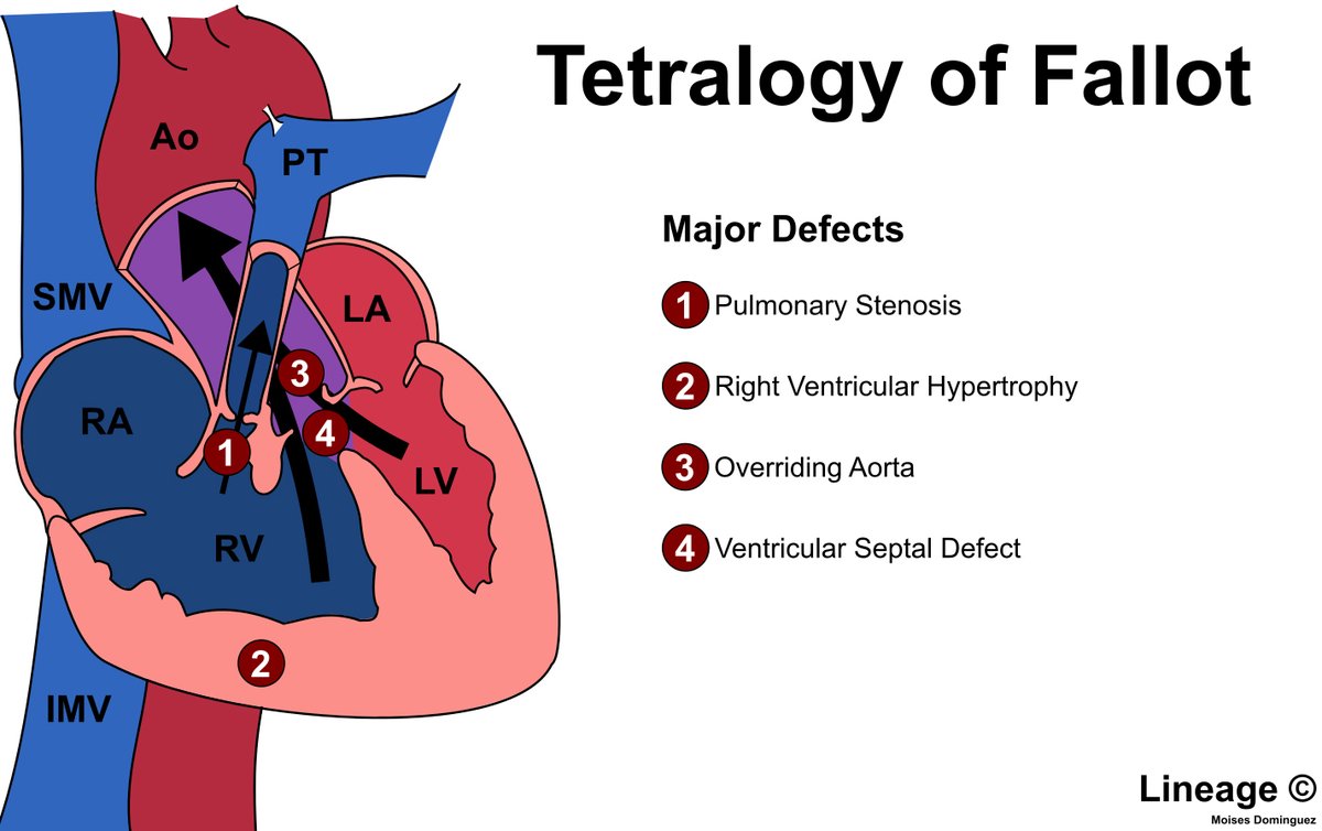 walinjom's tweet photo. Tetralogy of Fallot:

1. Pulmonary infundibular stenosis
2. Right ventricular hypertrophy (RVH)
3. Overriding aorta
4. Ventricular septal defect (VSD) https://t.co/dh9Uhxzalf