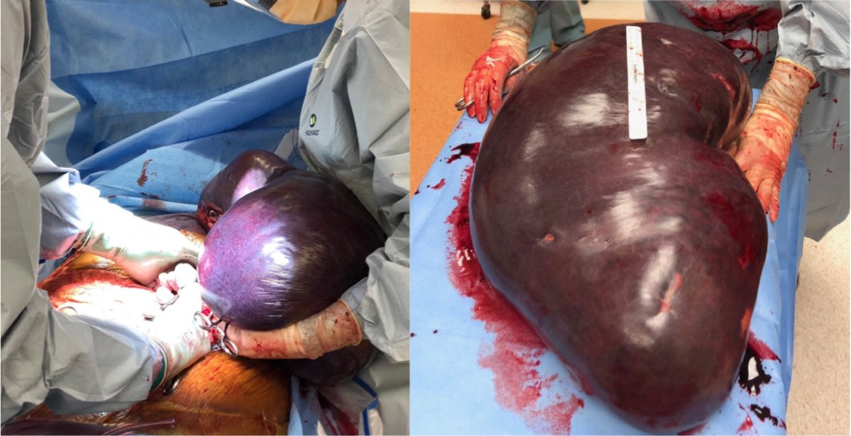 Patient with lymphoma undergoes abdominal surgery for pain and nausea. What’s the diagnosis?