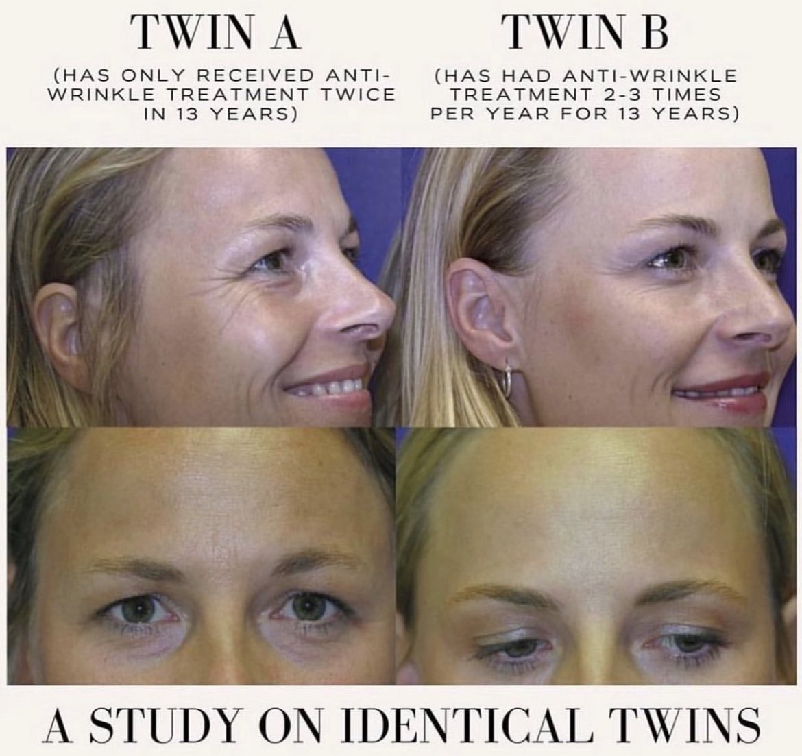 من الدراسات المثيرة في عالم البوتوكس للوقاية من التجاعيد والحفاظ على شباب الجلد دراسة متابعة لمدة طويلة بلغت 13 عاما على سيدتين توأم الاولى منهما أ A اجرت البوتوكس فقط مرتين على فترات متباعدة
بينما الاخرى بB دأبت على اجراء البوتوكس التجميلي على فترات منتظمة مرتين الى ثلاث مرات