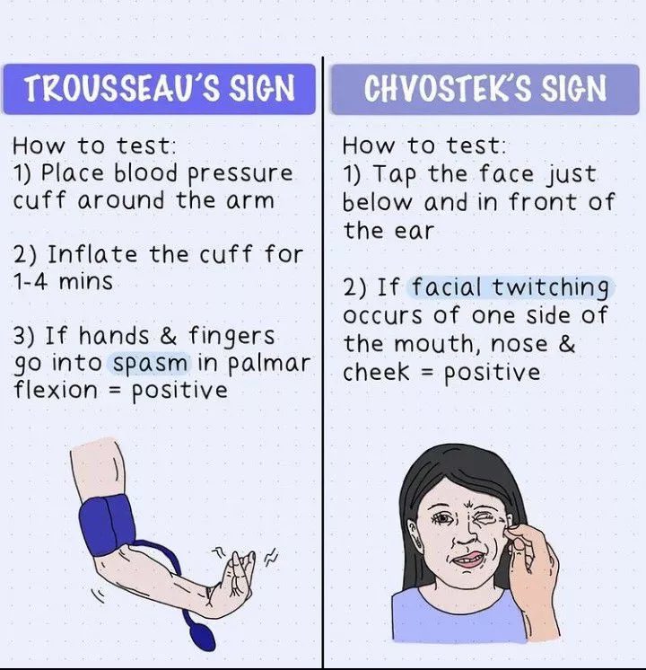 <a href="/BrownJHM/">Journal of Brown Hospital Medicine</a> Trousseau’s sign for latent tetany, positive in the setting of hypocalcemia. Carpopedal spasm induced by ischemia secondary to the inflation of a sphygmomanometer cuff, commonly on an individual’s arm, to 20 mmHg over their systolic blood pressure for 3 minutes.