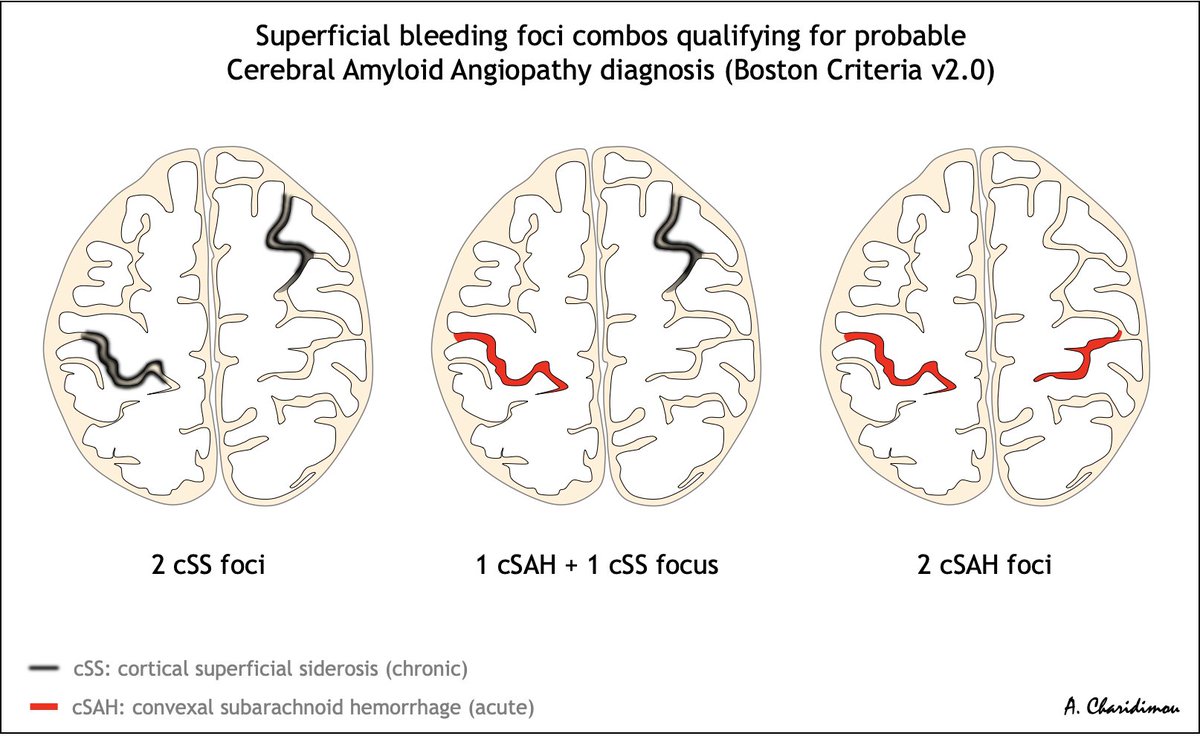 📌Cerebral Amyloid Angiopathy Diagnosis

🩸🧠Superficial bleeding combinations enough to diagnose probable CAA within the Boston Criteria v2.0 (in the absence of microbleeds or ICH)

#MedTwitter #MedStudentTwitter #MedEd #FOAMed
#neurotwitter #Neurology #stroke #Neurosurgery…