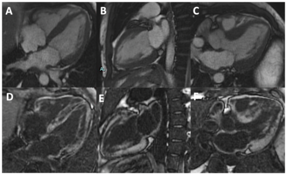 💡ICOT Clinical case of the week🧠
🫀 RISCONTRO OCCASIONALE DI TROMBO IN AURICOLA ATRIALE DESTRA IN UN GIOVANE PAZIENTE CON SCOMPENSO CARDIACO CONGESTIZIO E IN RITMO SINUSALE🫀
📌Caso clinico: italiancot.it/2023/06/03/ris…
#cardiology #cardiologia #cardiovascular #cardiac #ITcardiology