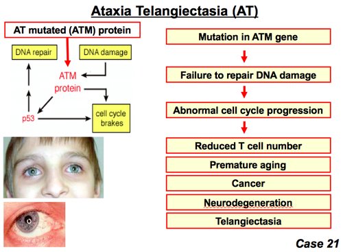 (2️⃣/n) Ataxia Telangiectasia- autosomal recessive,ATM mutation,dilated ocular vessels,unable to walk,nystagmus,severe IgA deficiency
Rx: supportive