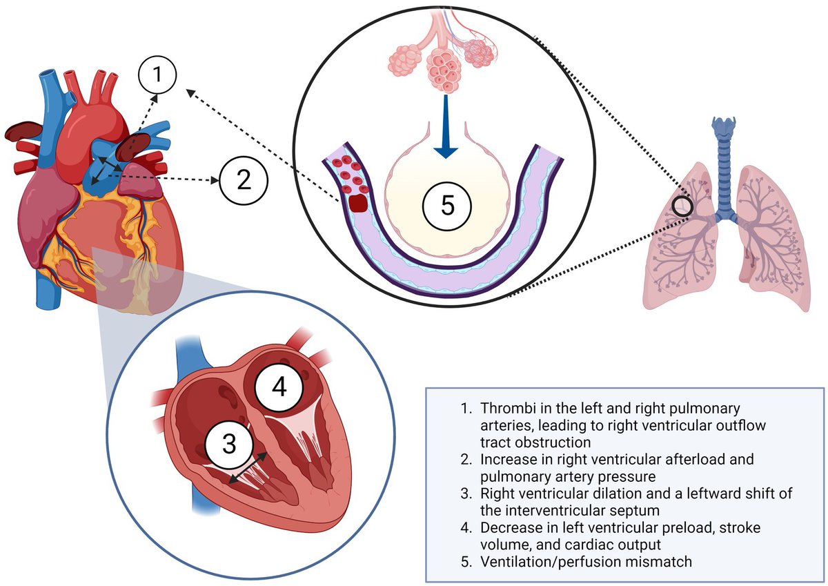 Hemodynamic and respiratory support in pulmonary embolism
<a href="/HectorMezaMD/">Hector Meza Comparan, MD</a>

CCR Journal Watch
criticalcarereviews.com/latest-evidenc…

Get the latest critical care literature every weekend via the CCR Newsletter - subscribe at criticalcarereviews.com/homepage/subsc…