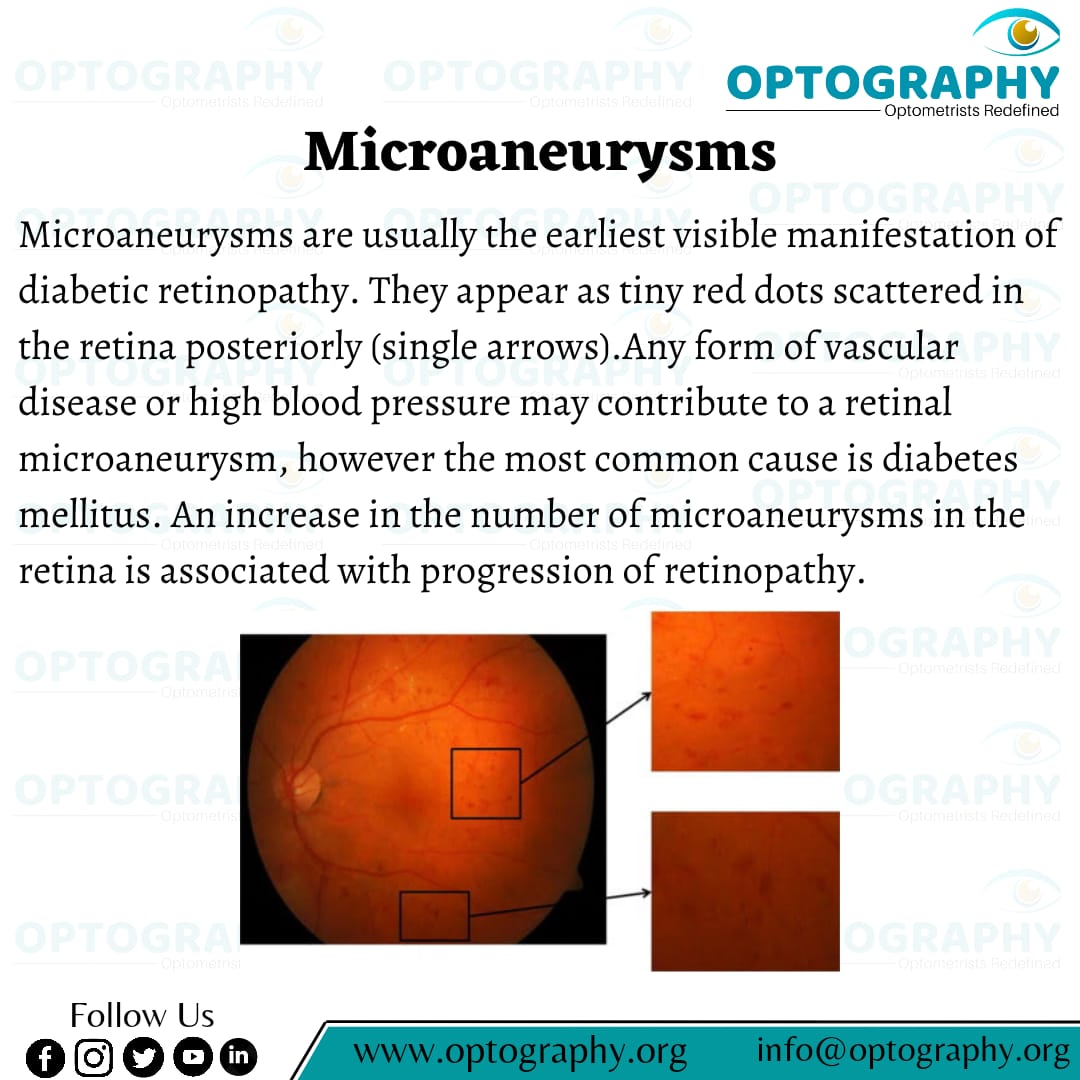 Microaneurysms are usually the earliest visible manifestation of diabetic retinopathy. They appear as tiny red dots scattered in the retina posteriorly (single arrows). They may be surrounded by a ring of yellow lipid, or hard, exudates (double arrow)

#eyecare #optography